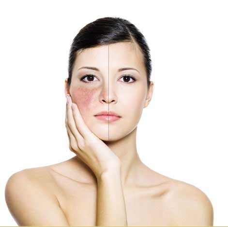 Thermavein Treatment